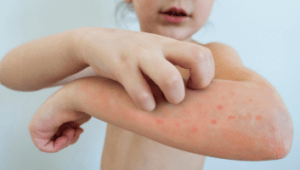 chickenpox vaccination Cardiff